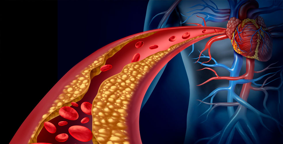 El colesterol LDL se acumula en las arterias desde joven y no da señales de alerta